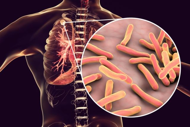 tuberculosis affects the lungs